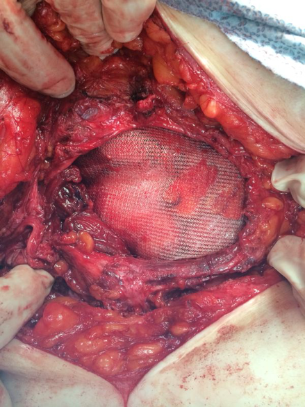 Cirugía de hernia umbilical en Monterrey